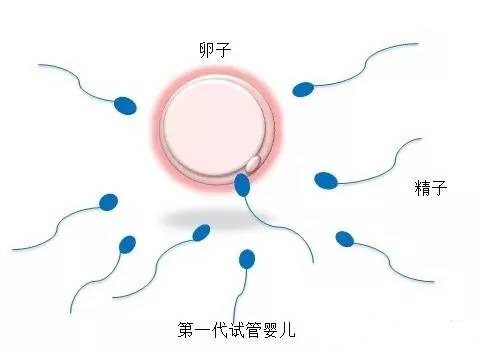 顕微授精 ICSI